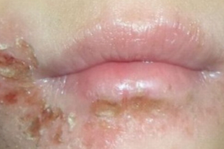 特应性皮炎口周结痂图