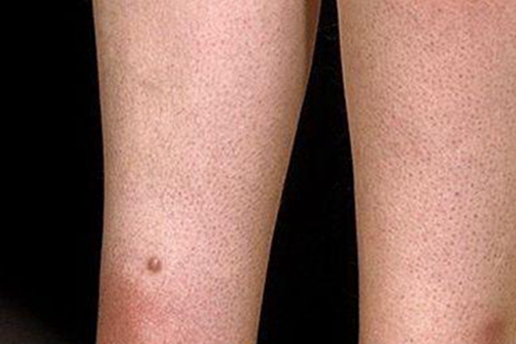 急性期硬化性脂膜炎小腿有红斑图