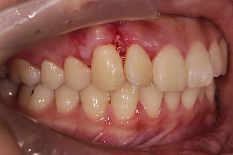 牙龈癌早期黏膜出血图