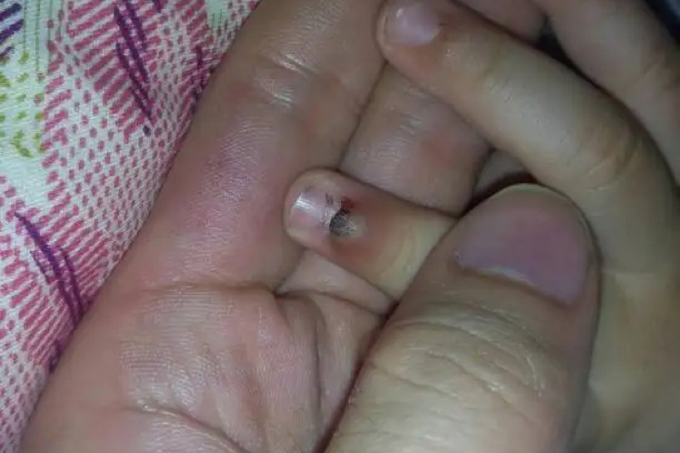 甲下出血指甲根部发紫图 甲下出血指甲根部发紫图