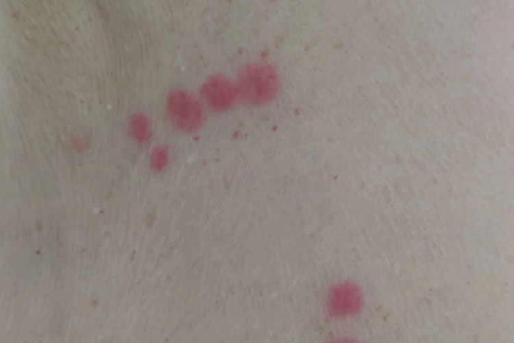 丘疹性荨麻疹胸部红点图