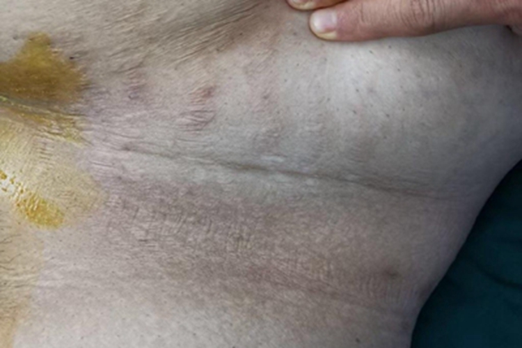 假性黑棘皮病大腿根变黑图