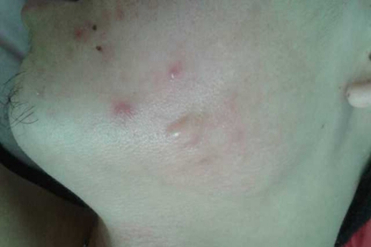 结节病下巴症状图