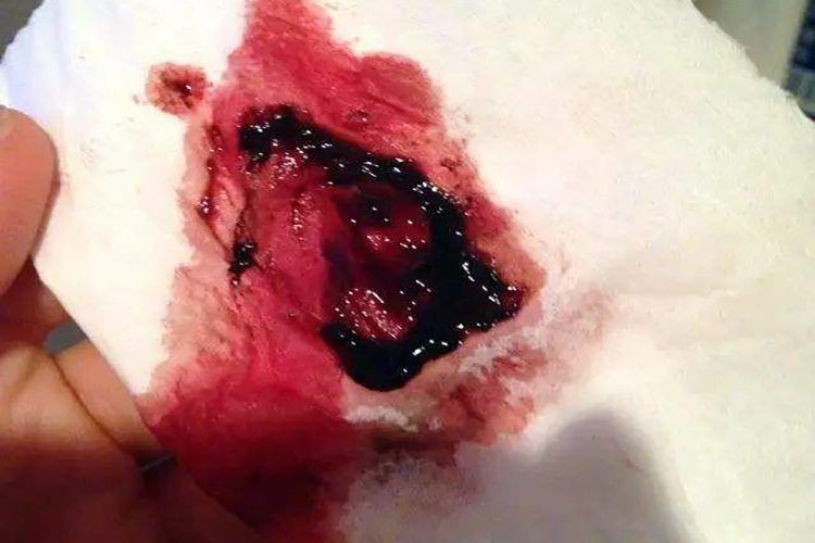 子宫肌瘤有血块图 子宫肌瘤有血块图