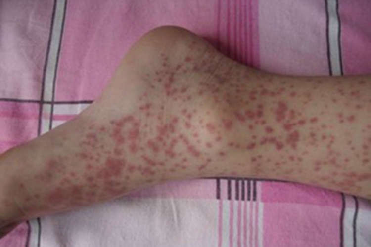 冷球蛋白血症脚背红点图