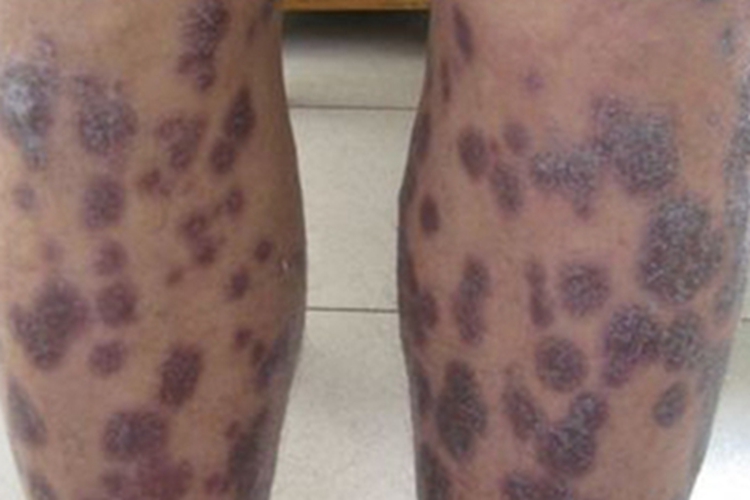 三期梅毒小腿症状图