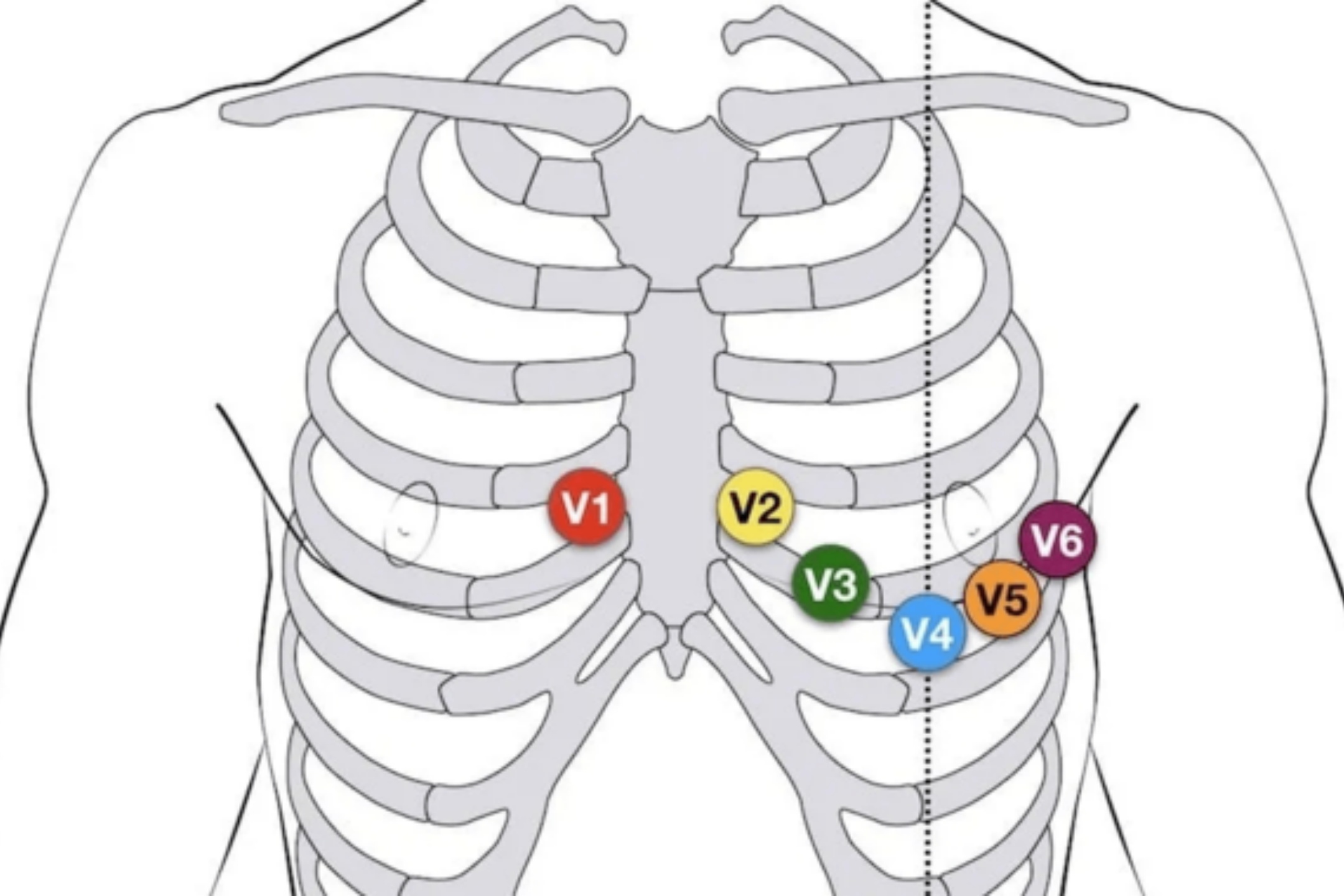 胸导联v1到v6的位置图片