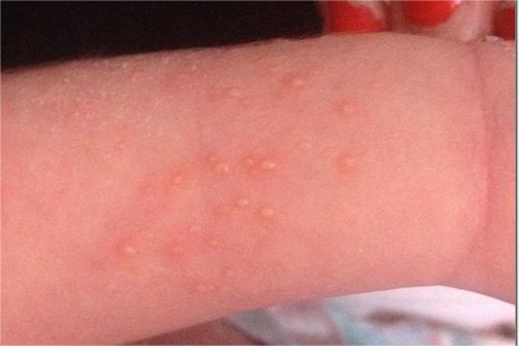 新生儿脓疱疮胳膊症状图