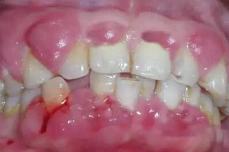 急性坏死性龈口炎包块图