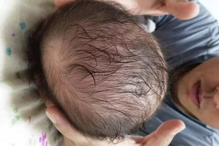 宝宝斜头畸形图