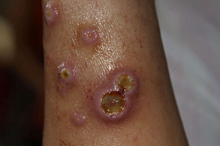 皮肤白喉胳膊症状图 皮肤白喉胳膊症状图