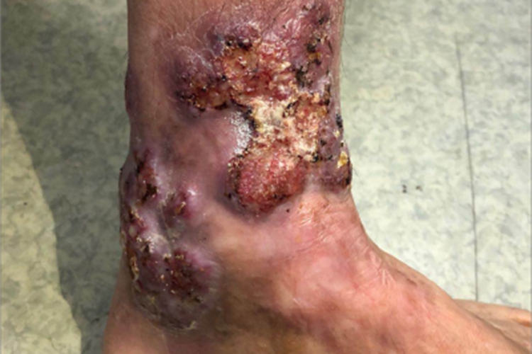 着色芽生菌病结节图