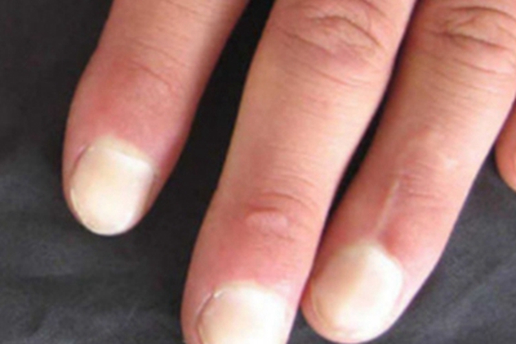 白甲手指甲发白图