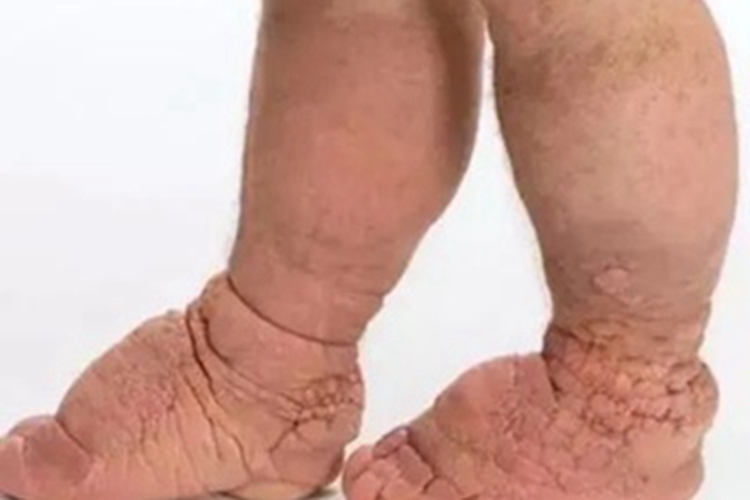 硬化性黏液水肿脚背结节图