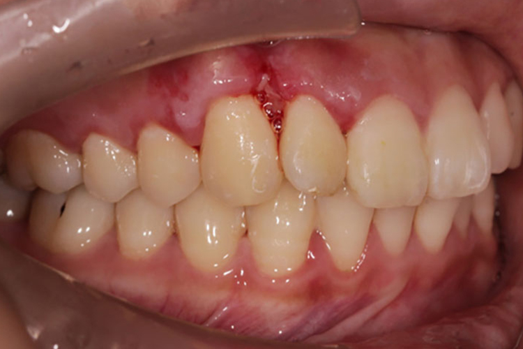 症状牙龈癌的发生可能与口腔卫生不良,不良义齿修复,癌前