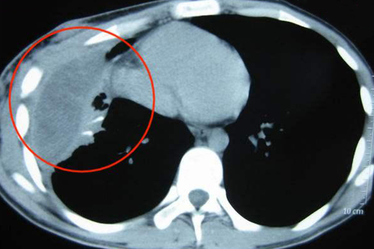 化脓性胸膜炎CT图