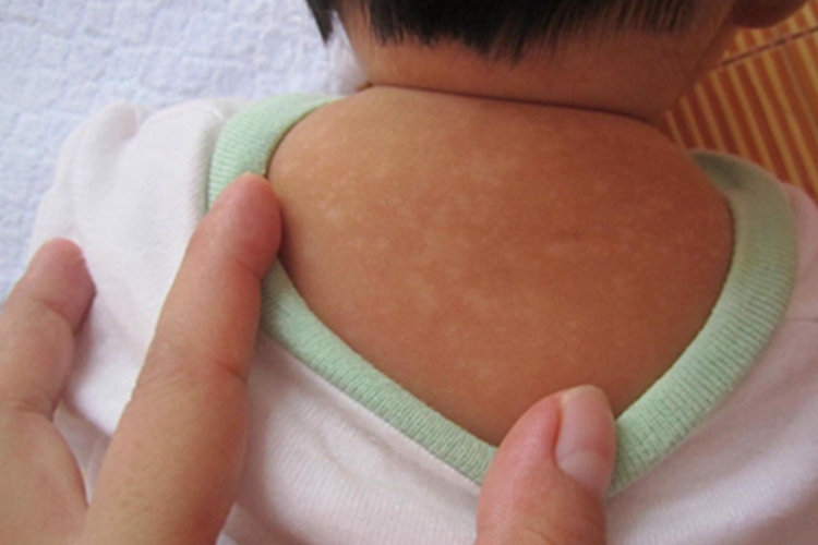 贫血痣背部白斑图