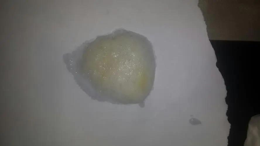 淡黄色黏液痰图 淡黄色黏液痰图