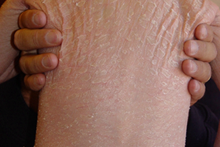 寻常型鱼鳞病背部脱皮图