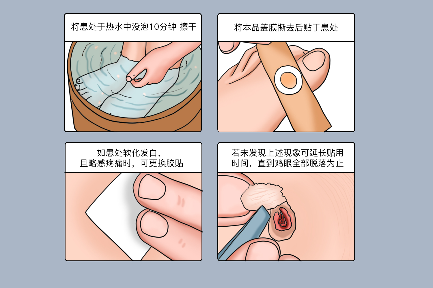 鸡眼膏贴治疗过程图 本文由有来医生原创,经专业医师审核校对