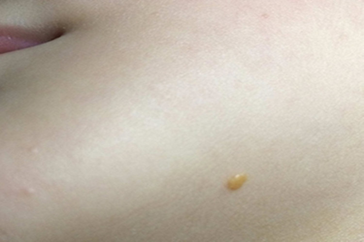 发疹性黄瘤下巴症状图