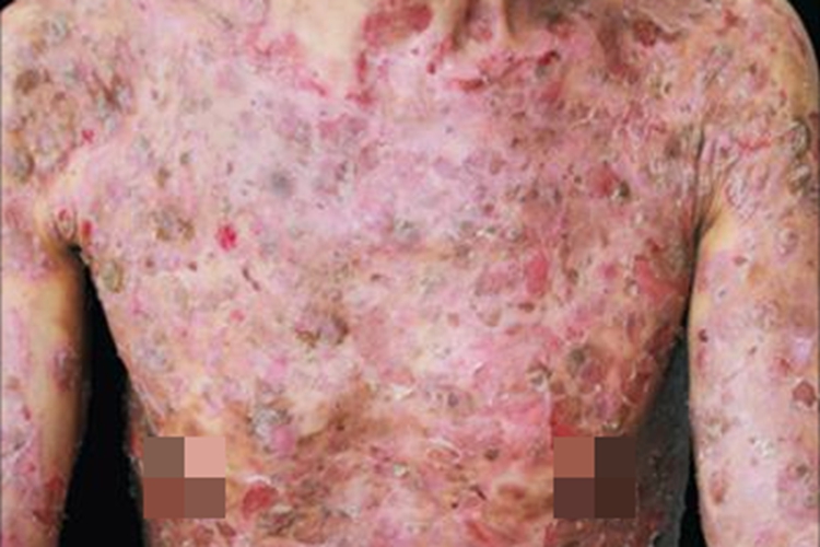 天疱疮胸部红斑图