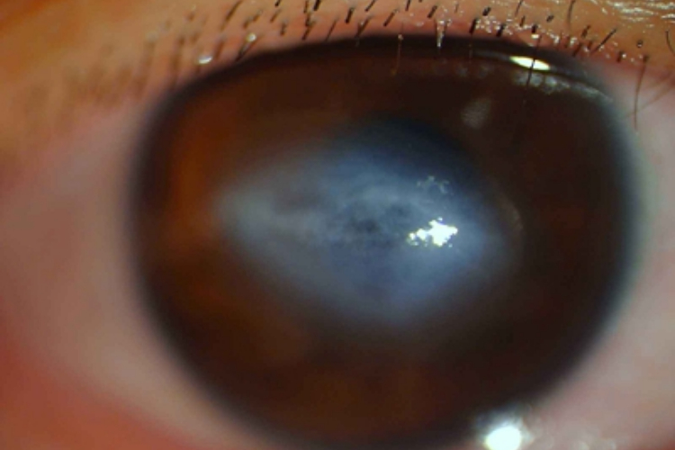 青光眼睫状体炎综合征白斑图