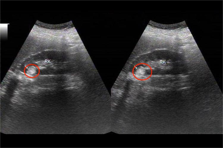 肾错构瘤超声圆形声像图