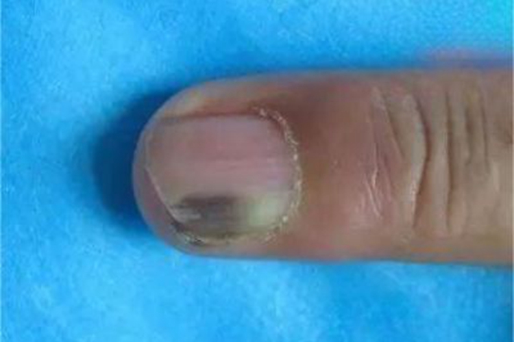 急性甲沟炎甲下脓肿图