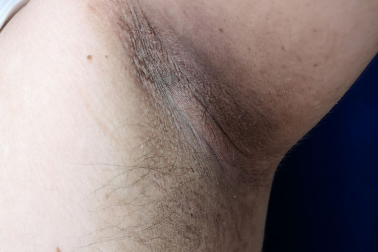 腋窝或腘窝部位黑棘皮病图 腋窝或腘窝部位黑棘皮病图