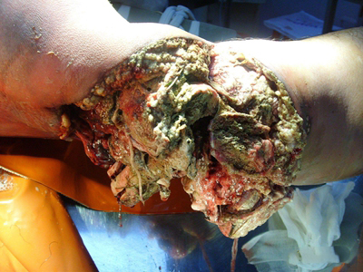 气性坏疽大腿上伤口内组织腐坏化脓图