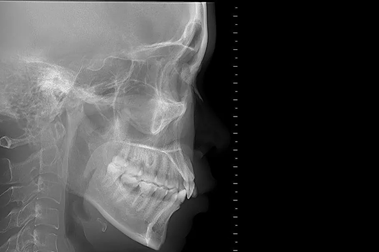 颞颌关节闭口位X线图 颞颌关节闭口位X线图