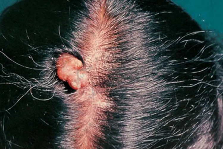 毛母质瘤头部症状图