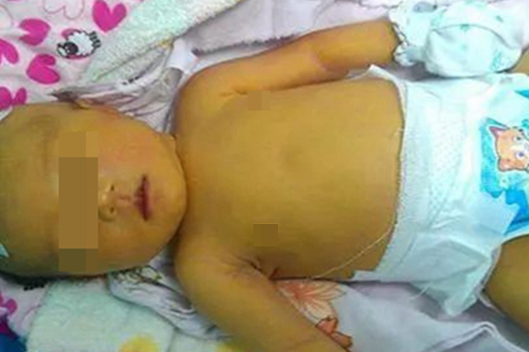 溶血性黄疸全身发黄图