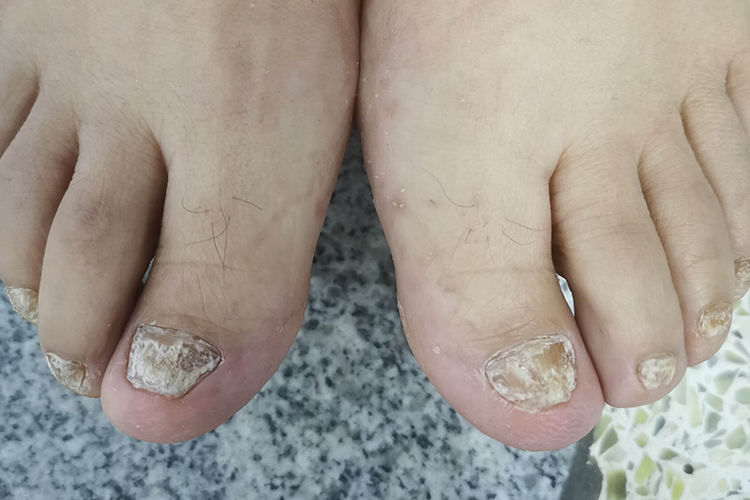 脚全甲毁损型甲真菌病图