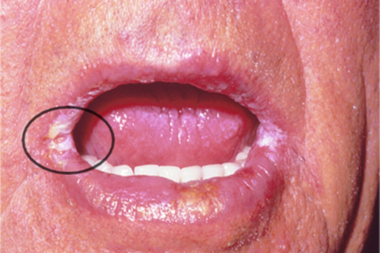 核黄素缺乏症糜烂图