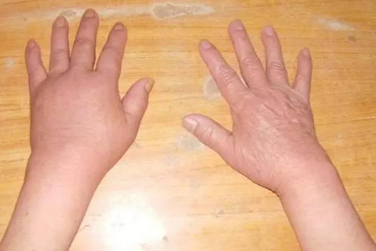 肩手综合征肿胀期患手肿胀图 肩手综合征肿胀期患手肿胀图