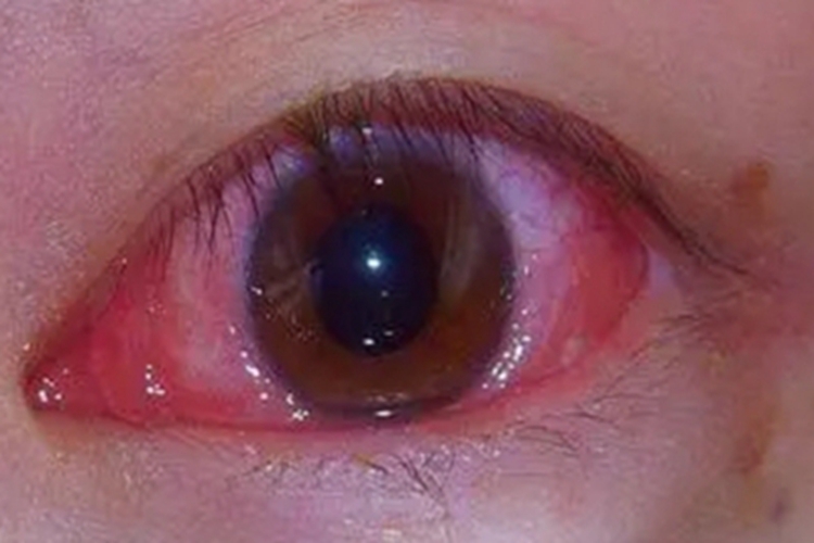 流行性角结膜炎眼球充血图