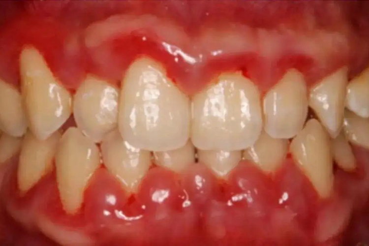 龈下刮治后牙龈肿胀图 龈下刮治后牙龈肿胀图