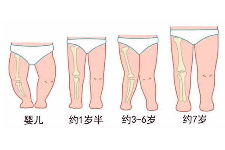 小孩正常腿型发展图