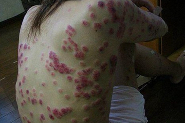 可变性红斑角化病背上大片红斑图