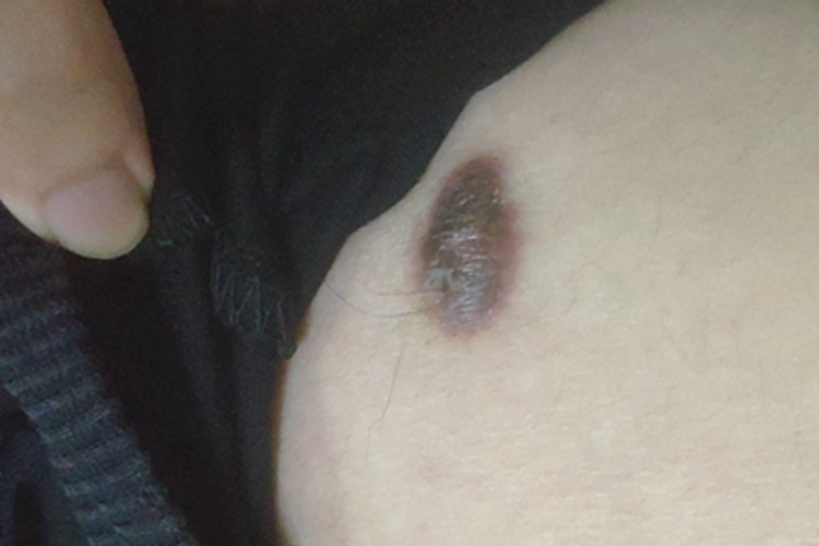 复合痣小腿有凸起黑痣图