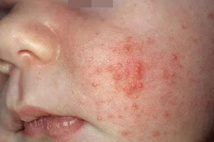 儿童丘疹性肢端皮炎面部症状图 儿童丘疹性肢端皮炎面部症状图