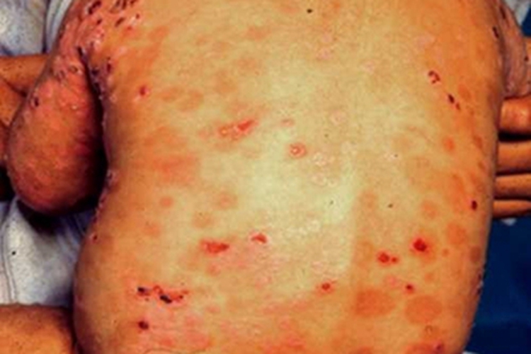 大疱性表皮松解症背部水疱图