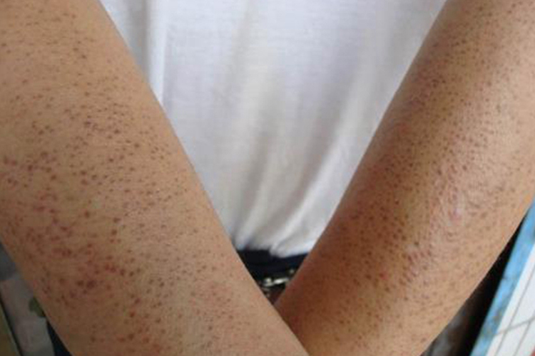 维生素A缺乏皮肤症状图 维生素A缺乏皮肤症状图