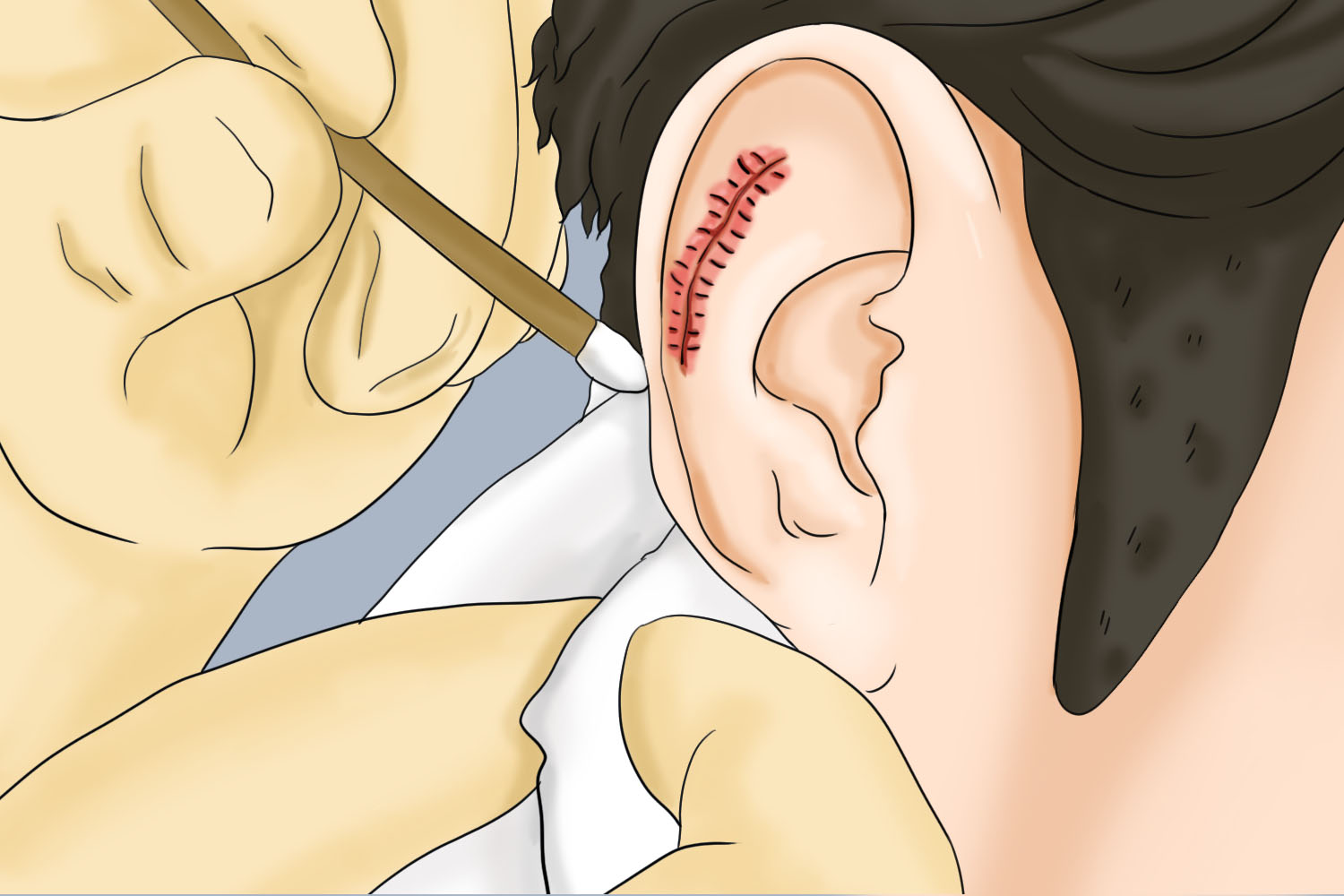 儿童耳朵缝针后拆线后图 儿童耳朵缝针后拆线后图