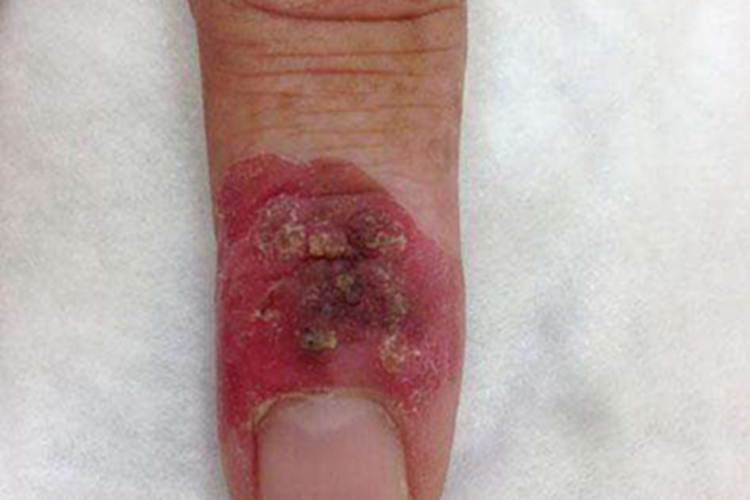皮肤白喉手指糜烂图