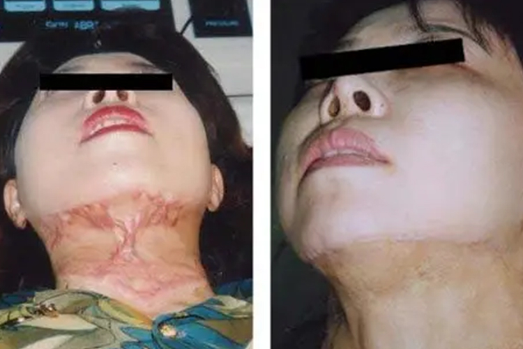 颈部植皮前后对比图 颈部植皮前后对比图