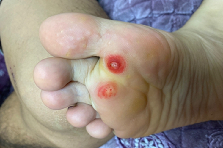 寻常疣脚底有丘疹图