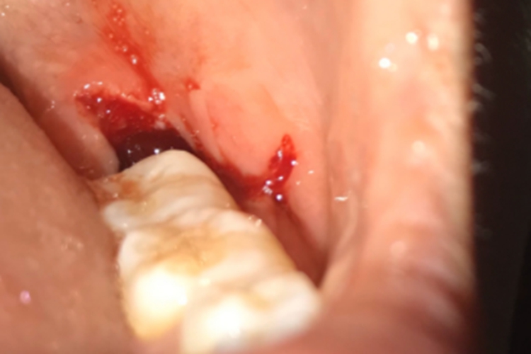 牙槽窝血凝块形成图